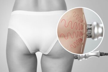 Mezoterapia bezigłowa