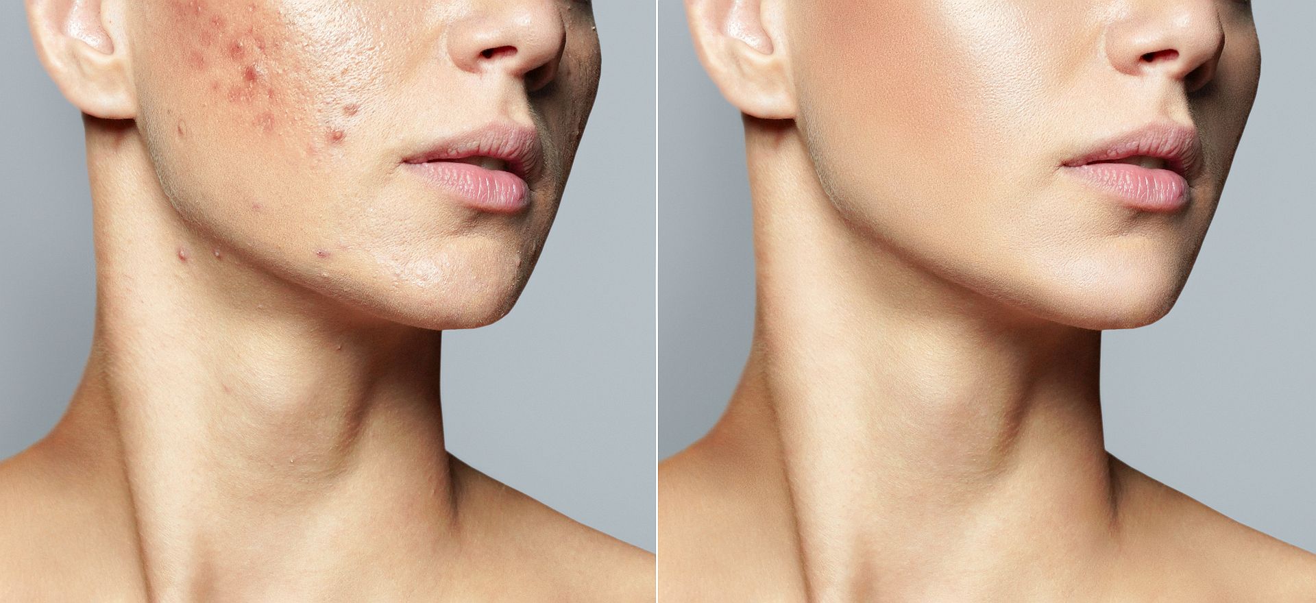 Teenage girl before and after acne treatment Skin care concept. Acne treatment in a cosmetology clinic